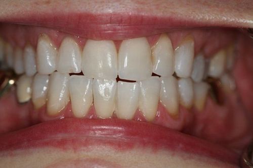 Teeth after whitening treatment.